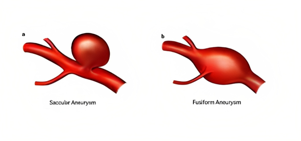 Types of Aneurysms - Embolism vs Aneurysm