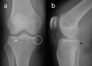 Segond Fracture