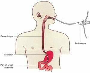 Endoscopic procedures