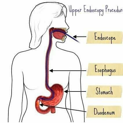 Endoscopic procedures - Upper GI