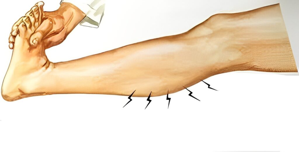 Homan's Sign: A Test for Diagnosing Deep Vein Thrombosis (DVT) - The ...