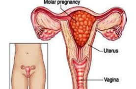 Molar Pregnancy - Gestational Trophoblastic Disease