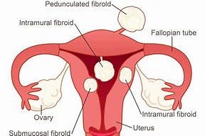 Types of Subserosal Fibroid