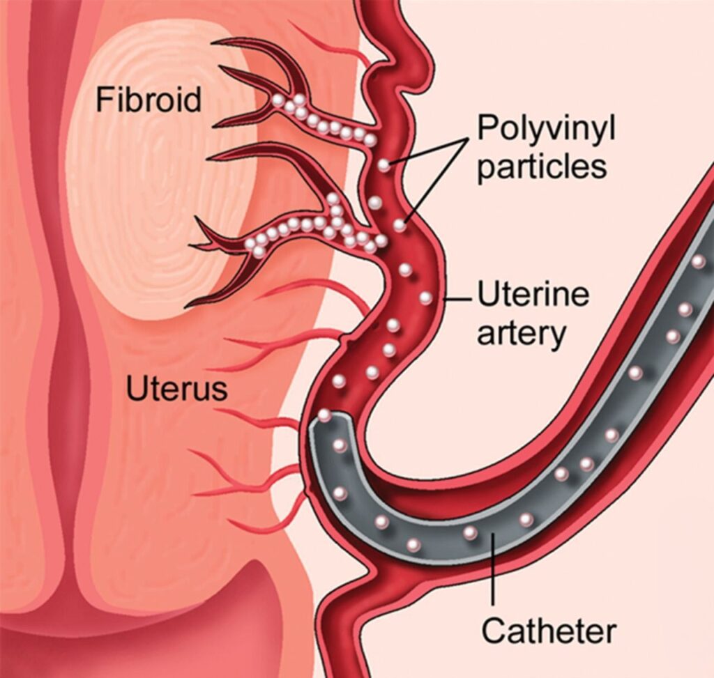 Uterine Fibroid Embolization A Minimally Invasive Treatment For Uterine Fibroid Embolization A Minimally Invasive Treatment For