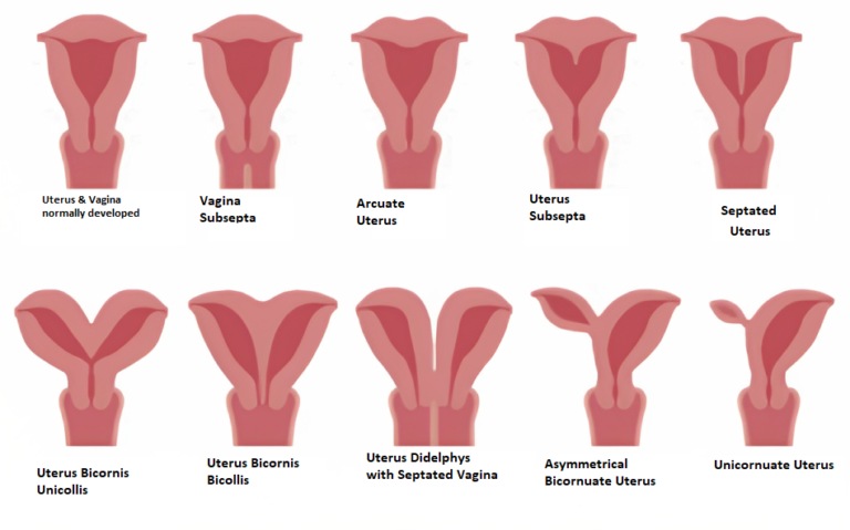 What Is Complete Uterus Didelphys And How Does It Affect Pregnancy In 6 what-is-complete-uterus-didelphys-and-how-does-it-affect-pregnancy-in-6