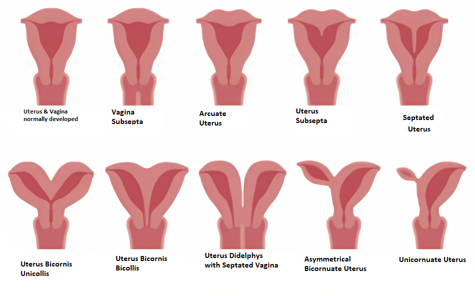 Uterus Malformation - Complete Uterus Didelphys 