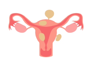 Uterine Fibroid Embolization - Common Locations of Fibroids
