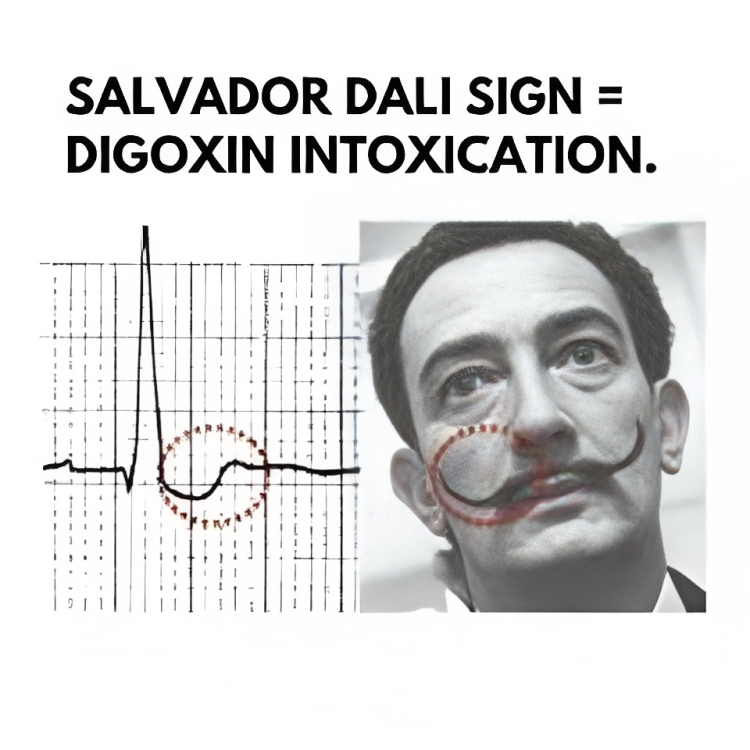 Salvador Dali Sign - Digoxin Toxicity EKG Findings