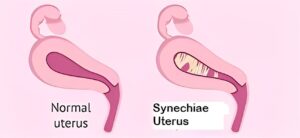 Synechiae Uterus