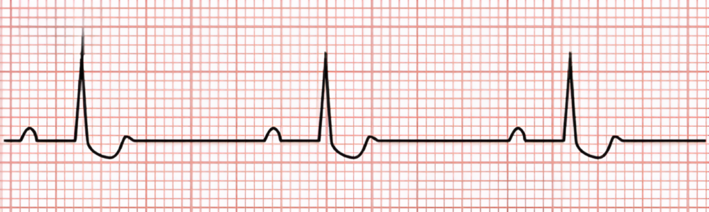 Digoxin Toxicity EKG findings: Scoped Out Pattern