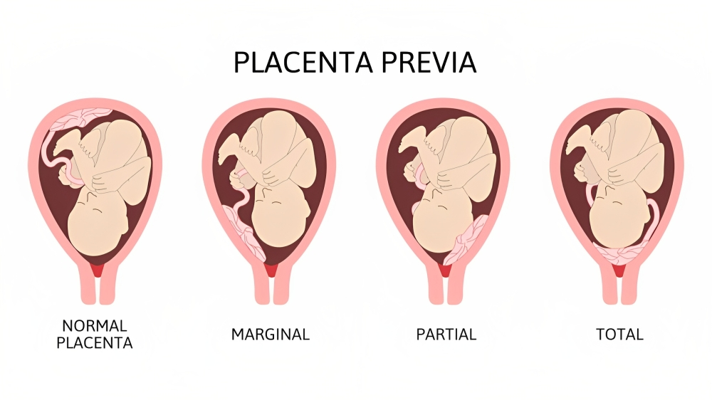 Placenta Previa Types: Placenta Previa Dos and Don'ts
